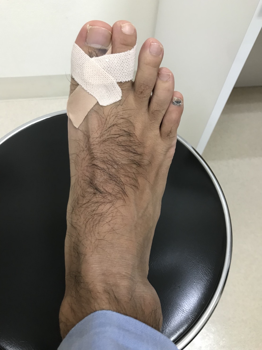 右足親指の骨折
