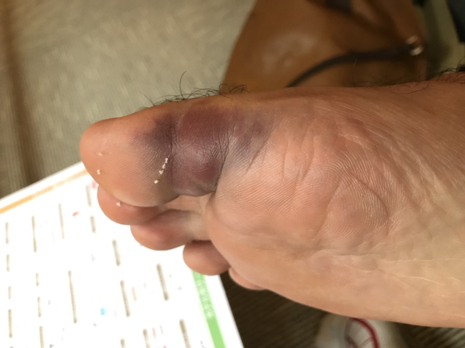 骨折した足の親指